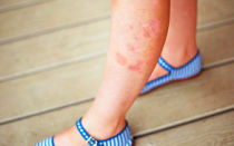 Псориаз на ногах: симптомы и лечение