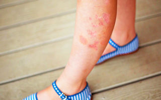 Псориаз на ногах: симптомы и лечение